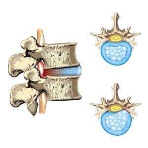 Lumbar Disc Pain